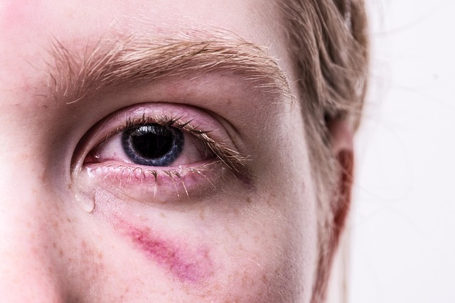 bruise in health-medical-4